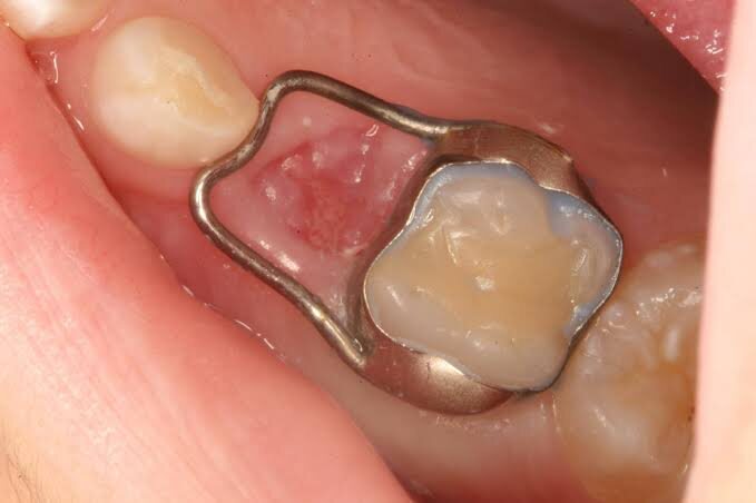 Child tooth extraction and space maintainer care