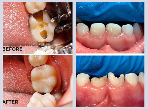 Tooth-coloured fillings for children