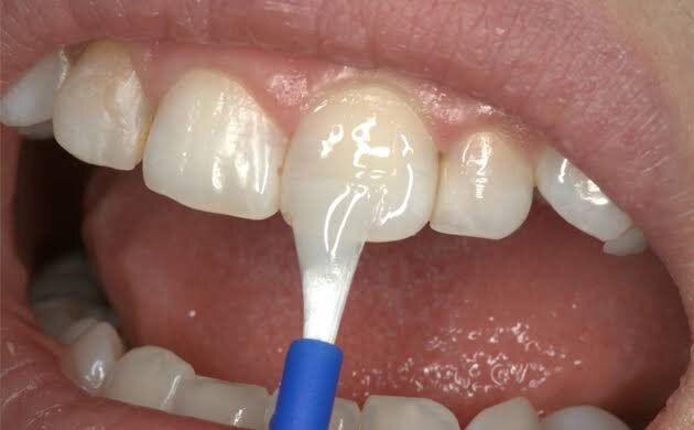 Fluoride treatment for cavity prevention in children